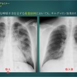 ノーベルファーマ、世界初の自己免疫性肺胞蛋白症治療薬を提供開始_専門医と患者がそのポイントを語る