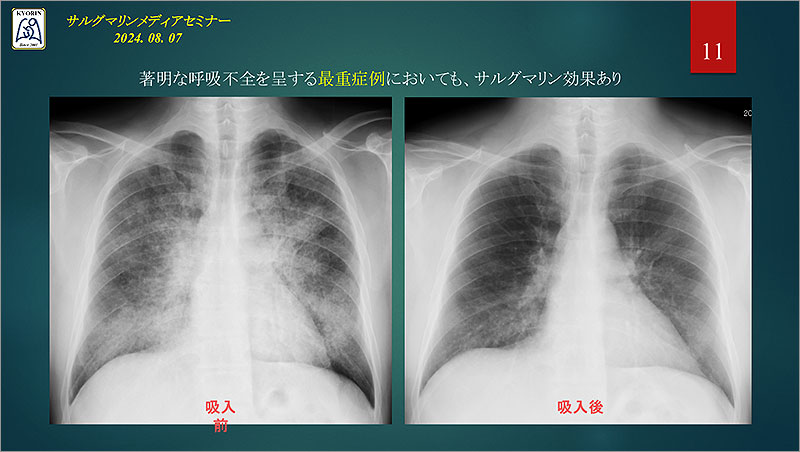 ノーベルファーマ、世界初の自己免疫性肺胞蛋白症治療薬を提供開始＿専門医と患者がそのポイントを語る | tokyo chips